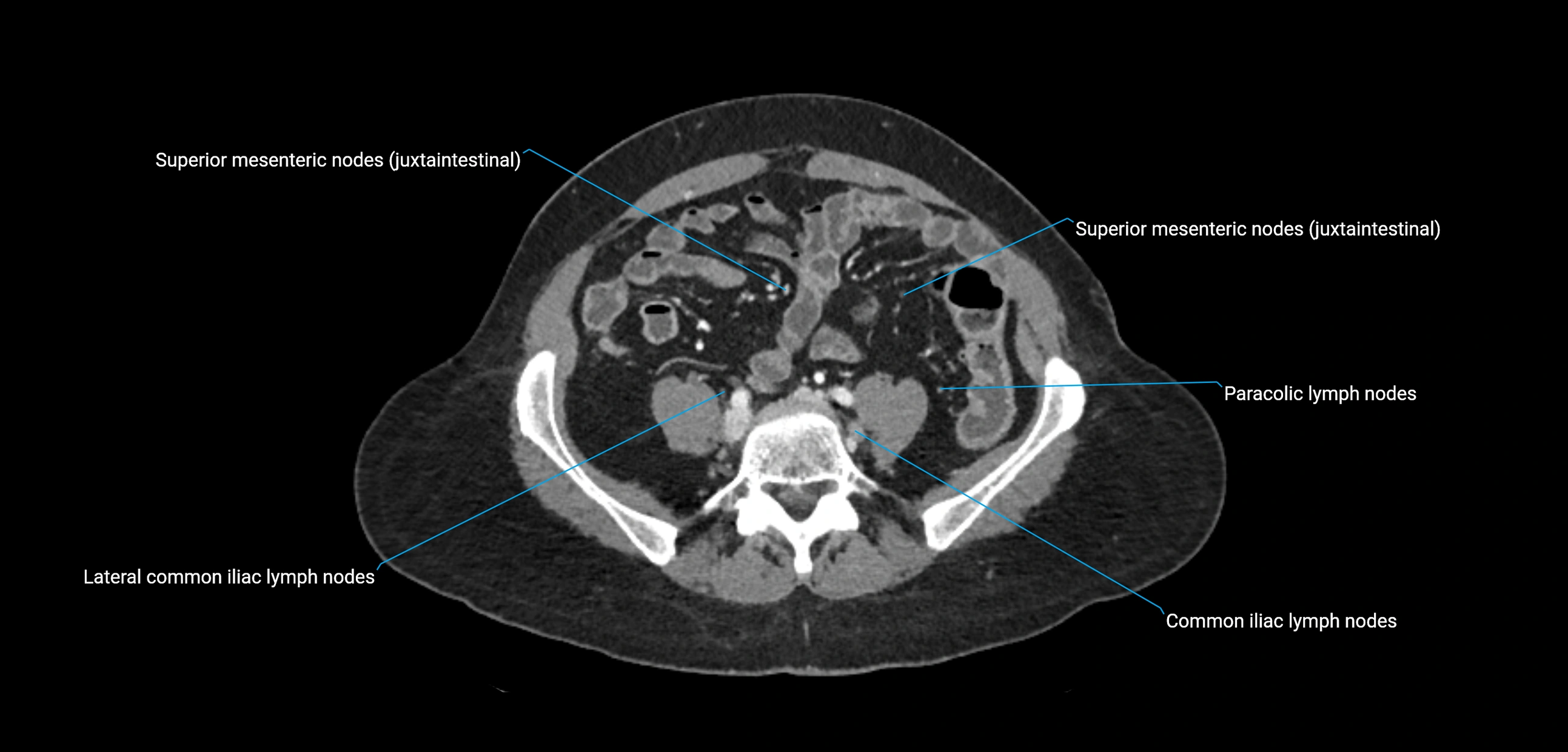CT ct abdominal lymph nodes  axial cross sectional anatomy  enchanced radiology image -img-00002-00297.webp